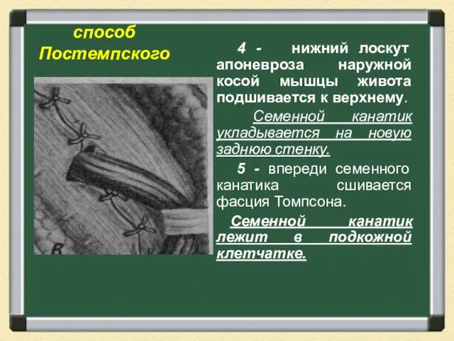 способ Постемпского 4 - нижний лоскут апоневроза наружной косой мышцы живота