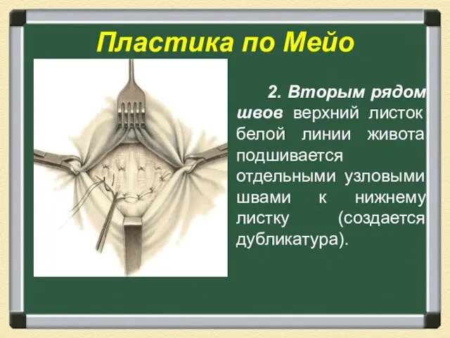 Пластика по Мейо 2. Вторым рядом швов верхний листок белой линии