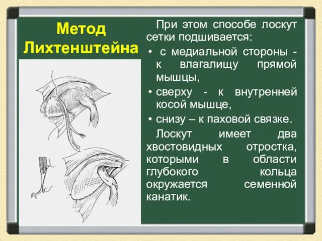 Метод Лихтенштейна При этом способе лоскут сетки подшивается: с медиальной стороны