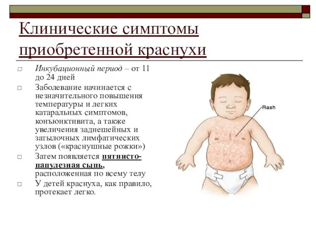 Клинические симптомы приобретенной краснухи Инкубационный период – от 11 до 24