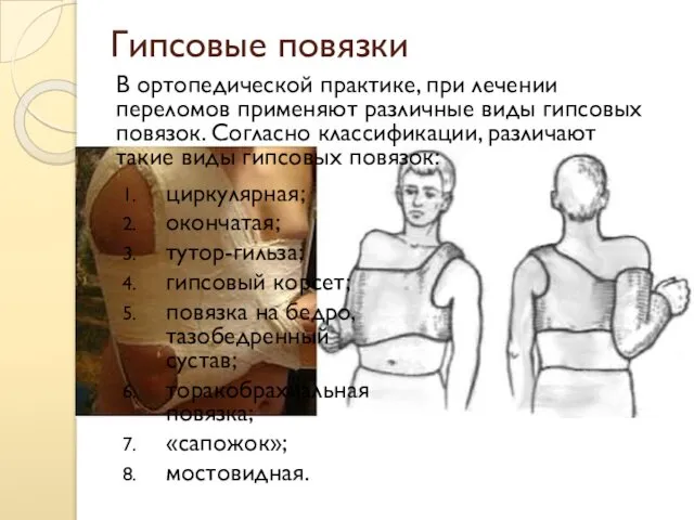 Гипсовые повязки циркулярная; окончатая; тутор-гильза; гипсовый корсет; повязка на бедро, тазобедренный