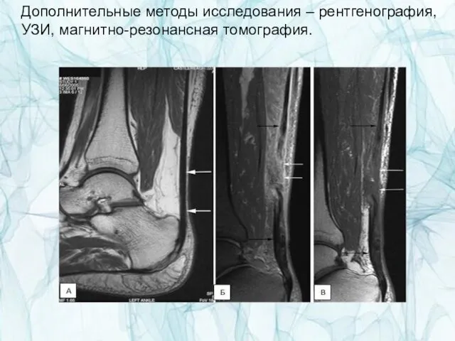 Дополнительные методы исследования – рентгенография, УЗИ, магнитно-резонансная томография.