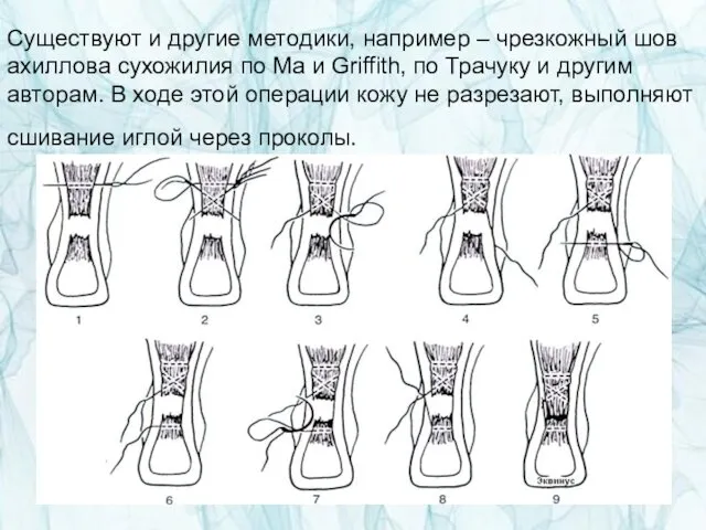 Существуют и другие методики, например – чрезкожный шов ахиллова сухожилия по