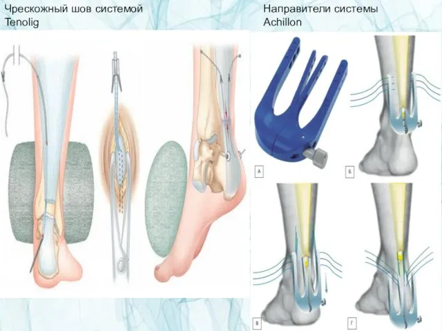 Чрескожный шов системой Tenolig Направители системы Achillon