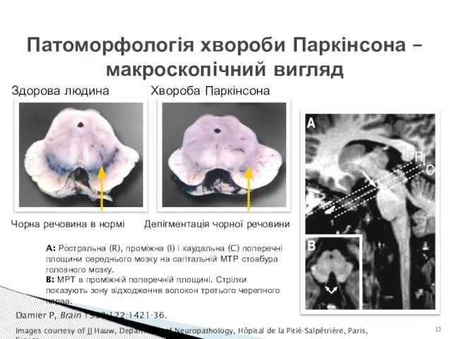 Патоморфологія хвороби Паркінсона – макроскопічний вигляд Damier P, Brain 1999;122:1421-36. Images