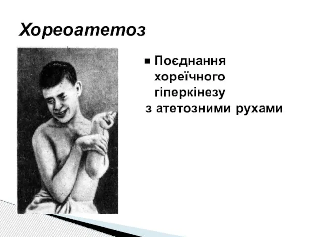 Хореоатетоз Поєднання хореїчного гіперкінезу з атетозними рухами