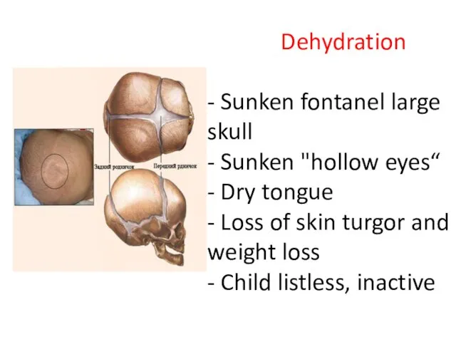 Dehydration - Sunken fontanel large skull - Sunken "hollow eyes“ -