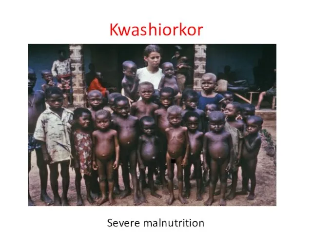 Kwashiorkor Severe malnutrition