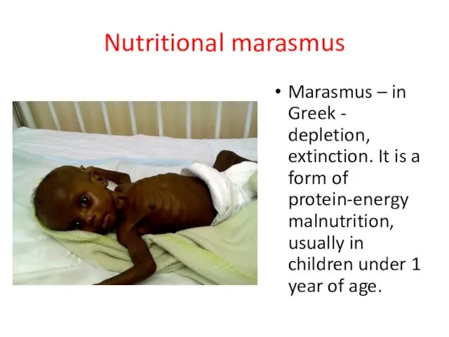 Nutritional marasmus Marasmus – in Greek - depletion, extinction. It is