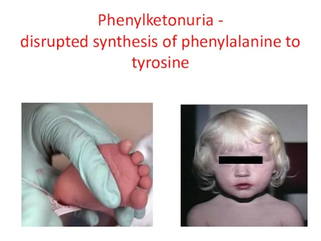 Phenylketonuria - disrupted synthesis of phenylalanine to tyrosine