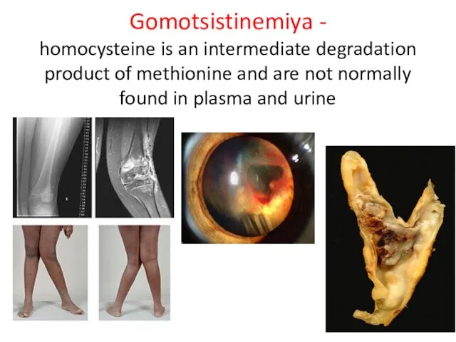 Gomotsistinemiya - homocysteine ​​is an intermediate degradation product of methionine and