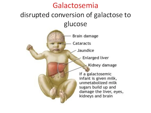 Galactosemia disrupted conversion of galactose to glucose