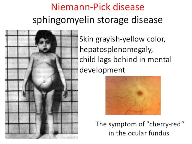 Niemann-Pick disease sphingomyelin storage disease Skin grayish-yellow color, hepatosplenomegaly, child lags