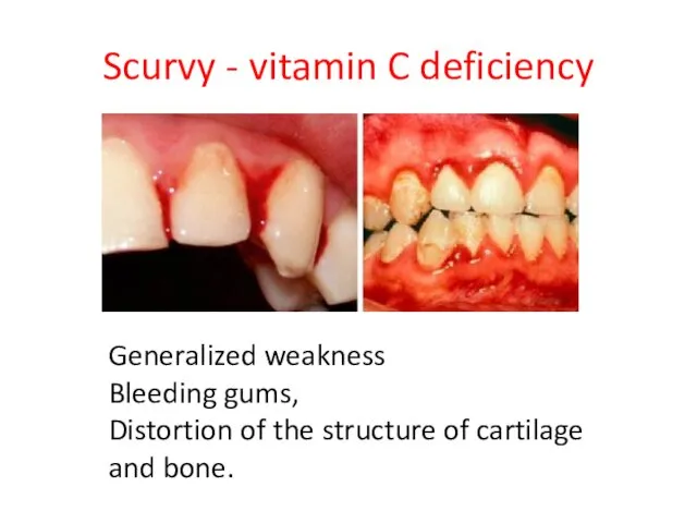 Scurvy - vitamin C deficiency Generalized weakness Bleeding gums, Distortion of