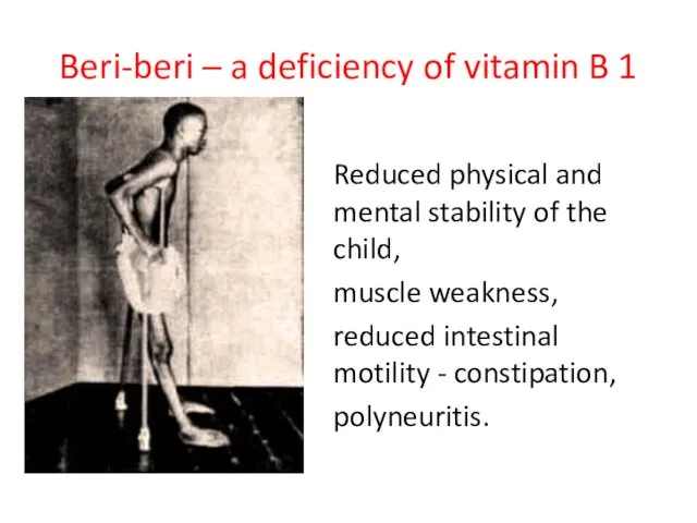 Beri-beri – a deficiency of vitamin B 1 Reduced physical and