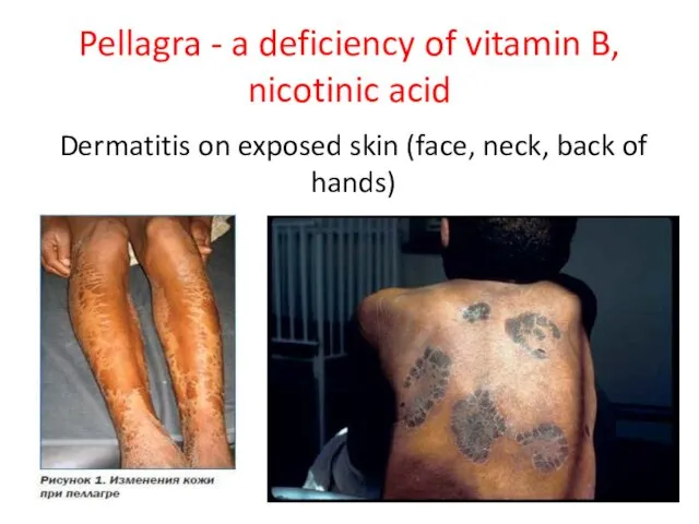 Pellagra - a deficiency of vitamin B, nicotinic acid Dermatitis on