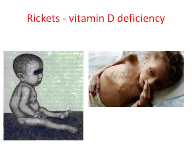 Rickets - vitamin D deficiency