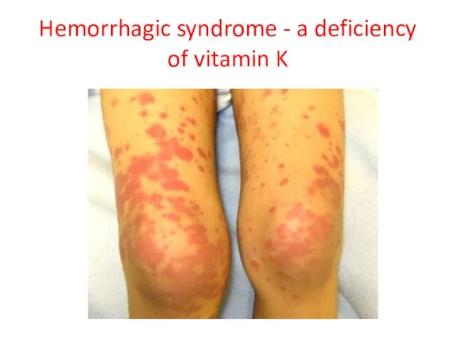 Hemorrhagic syndrome - a deficiency of vitamin K
