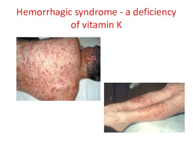 Hemorrhagic syndrome - a deficiency of vitamin K