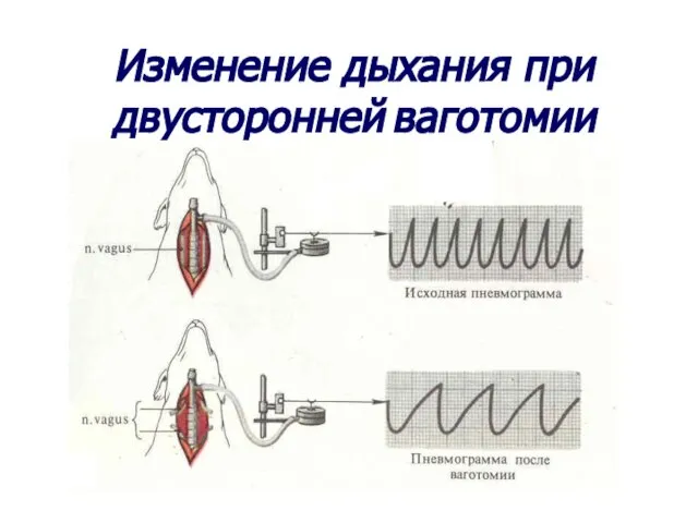 Изменение дыхания при двусторонней ваготомии