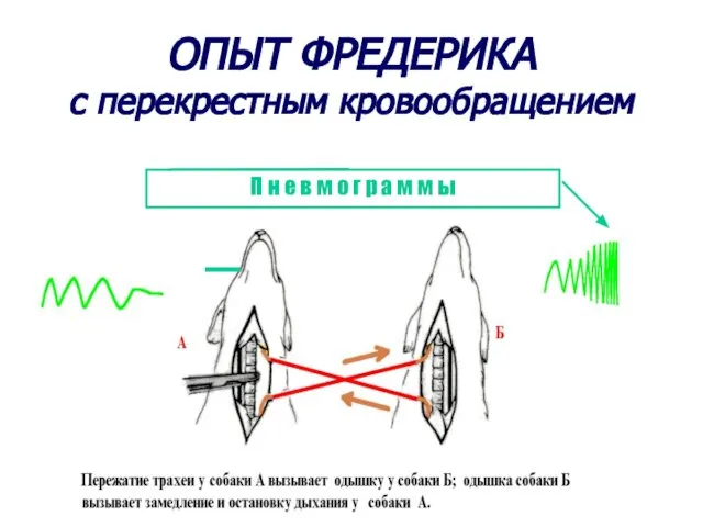 ОПЫТ ФРЕДЕРИКА с перекрестным кровообращением П н е в м о