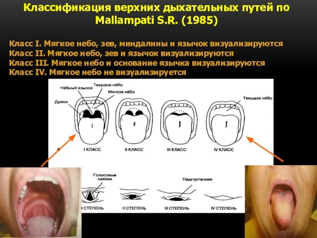 Классификация верхних дыхательных путей по Mallampati S.R. (1985) Класс I. Мягкое