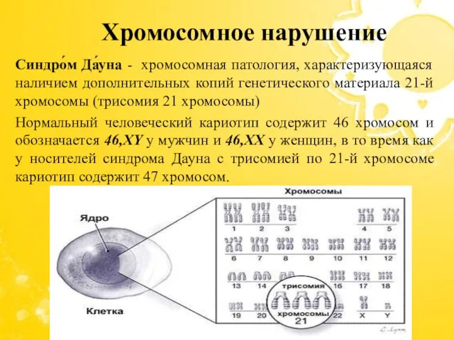 Синдро́м Да́уна - хромосомная патология, характеризующаяся наличием дополнительных копий генетического материала