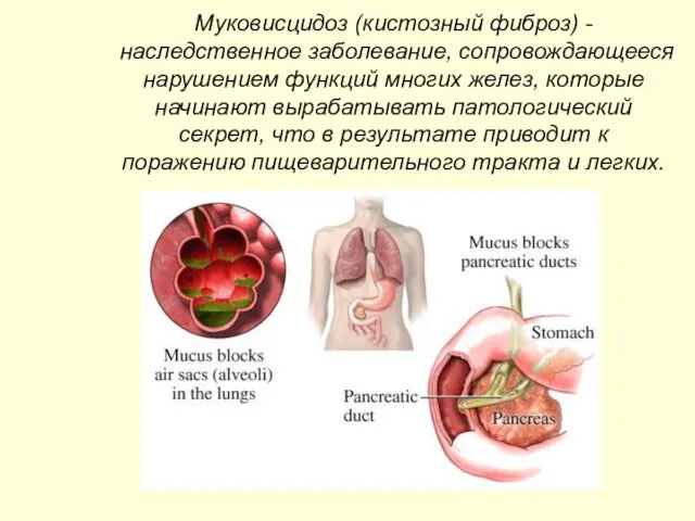 Муковисцидоз (кистозный фиброз) - наследственное заболевание, сопровождающееся нарушением функций многих желез,