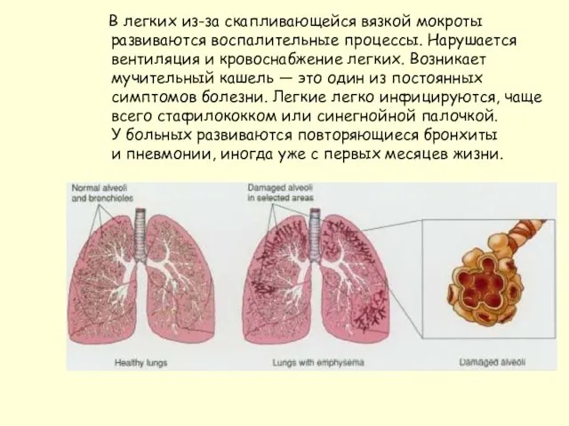 В легких из-за скапливающейся вязкой мокроты развиваются воспалительные процессы. Нарушается вентиляция