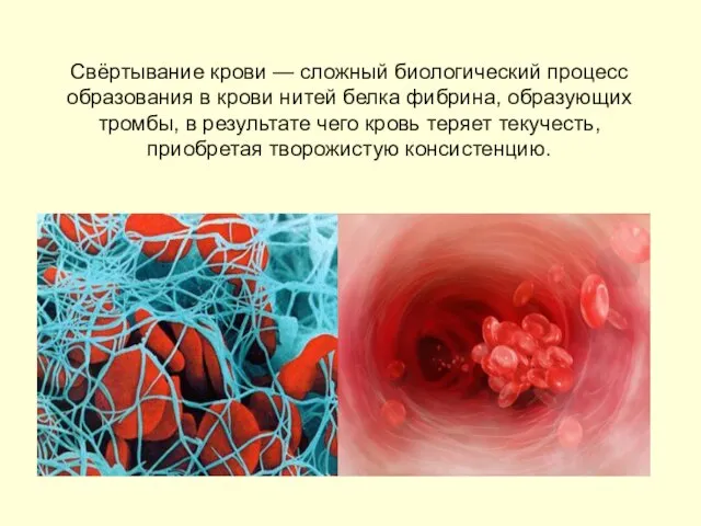 Свёртывание крови — сложный биологический процесс образования в крови нитей белка