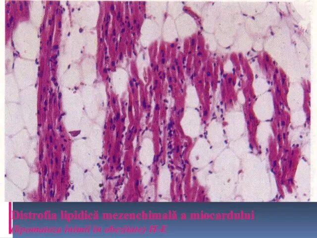 Distrofia lipidică mezenchimală a miocardului (lipomatoza inimii în obezitate) H-E