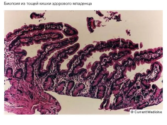 Биопсия из тощей кишки здорового младенца