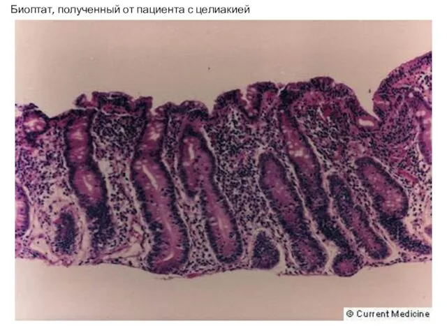 Биоптат, полученный от пациента с целиакией