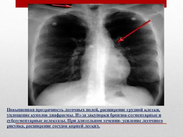 Повышенная прозрачность легочных полей, расширение грудной клетки, уплощение куполов диафрагмы. Из-за