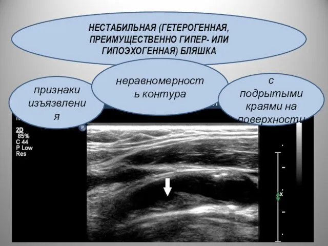 НЕСТАБИЛЬНАЯ (ГЕТЕРОГЕННАЯ, ПРЕИМУЩЕСТВЕННО ГИПЕР- ИЛИ ГИПОЭХОГЕННАЯ) БЛЯШКА признаки изъязвления неравномерность контура с подрытыми краями на поверхности
