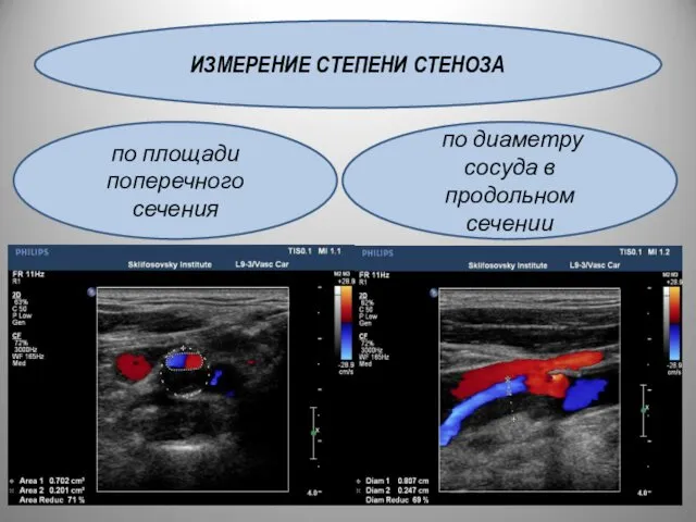 ИЗМЕРЕНИЕ СТЕПЕНИ СТЕНОЗА по площади поперечного сечения по диаметру сосуда в продольном сечении