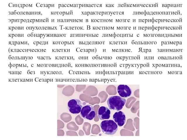 Синдром Сезари рассматривается как лейкемический вариант заболевания, который характеризуется лимфаденопатией, эритродермией