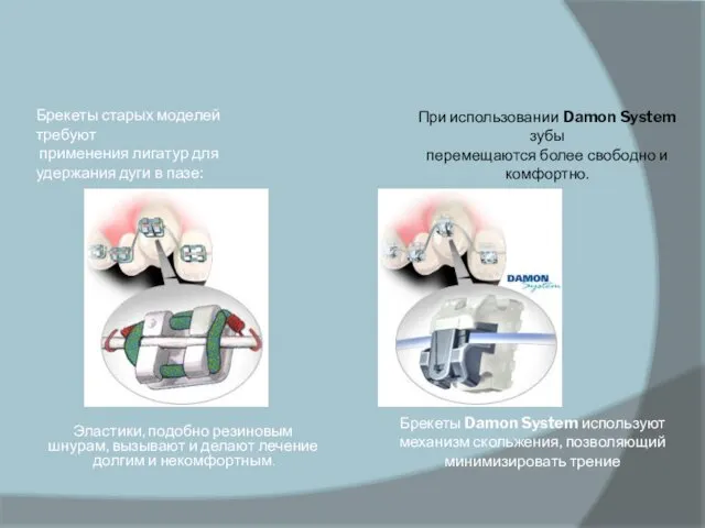 Брекеты старых моделей требуют применения лигатур для удержания дуги в пазе: