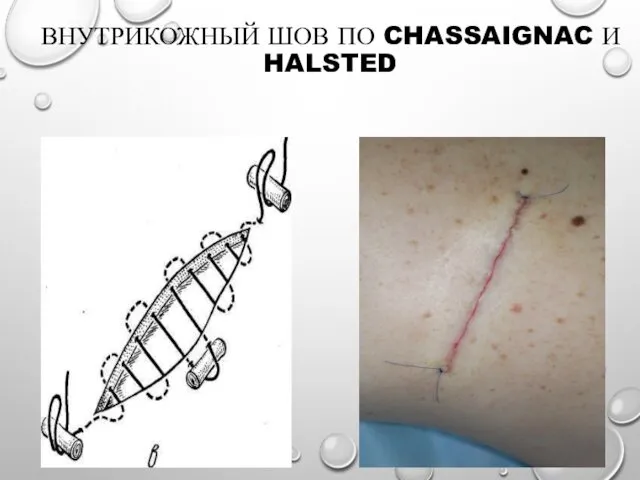 ВНУТРИКОЖНЫЙ ШОВ ПО CHASSAIGNAC И HALSTED