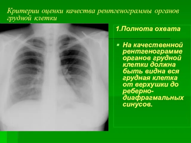 Критерии оценки качества рентгенограммы органов грудной клетки 1.Полнота охвата На качественной