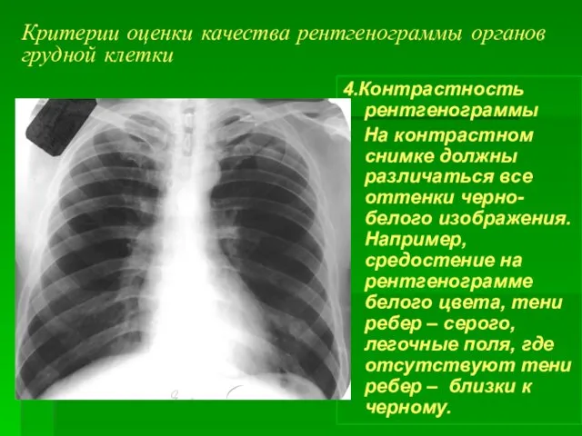 Критерии оценки качества рентгенограммы органов грудной клетки 4.Контрастность рентгенограммы На контрастном