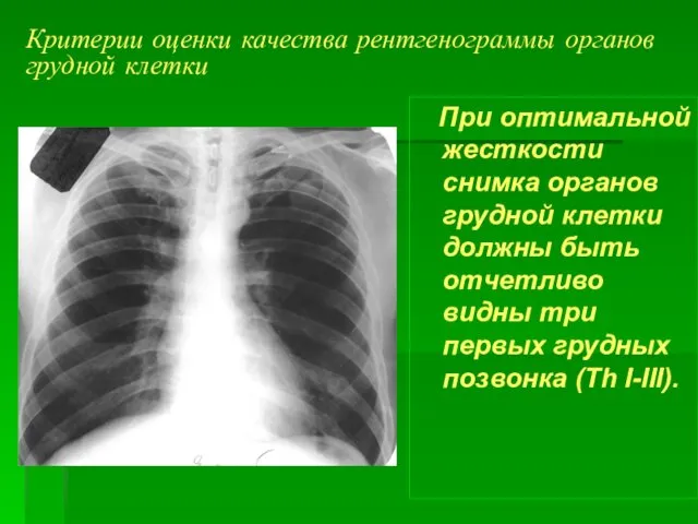 Критерии оценки качества рентгенограммы органов грудной клетки При оптимальной жесткости снимка