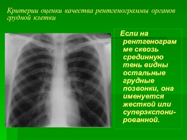 Критерии оценки качества рентгенограммы органов грудной клетки Если на рентгенограмме сквозь