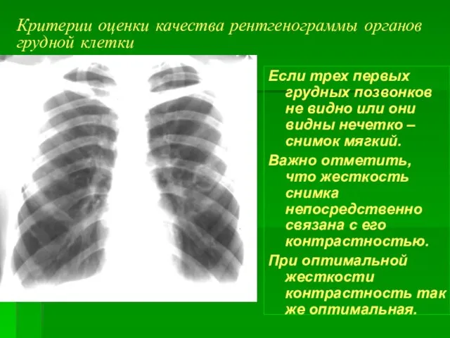 Критерии оценки качества рентгенограммы органов грудной клетки Если трех первых грудных