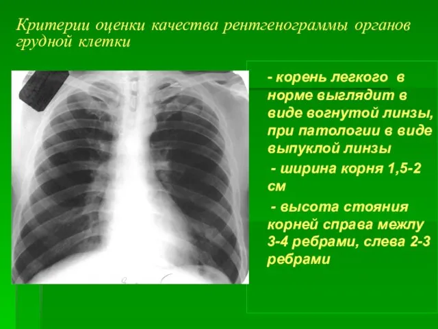 Критерии оценки качества рентгенограммы органов грудной клетки - корень легкого в