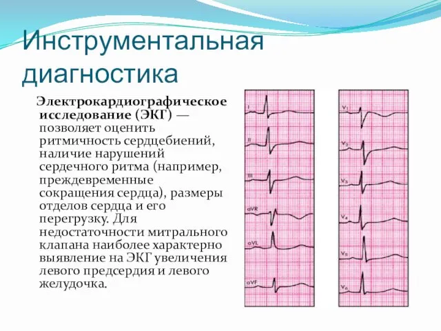 Инструментальная диагностика Электрокардиографическое исследование (ЭКГ) — позволяет оценить ритмичность сердцебиений, наличие