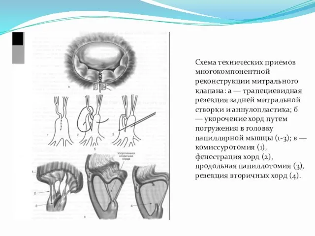 Схема технических приемов многокомпонентной реконструкции митрального клапана: а — трапециевидная резекция