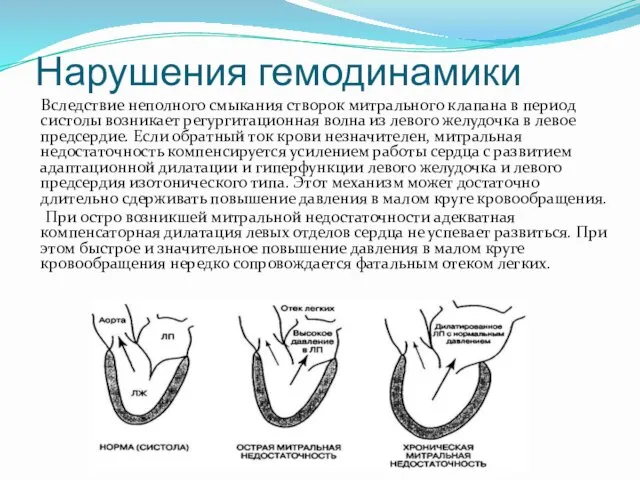 Нарушения гемодинамики Вследствие неполного смыкания створок митрального клапана в период систолы