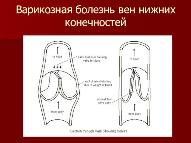 Варикозная болезнь вен нижних конечностей