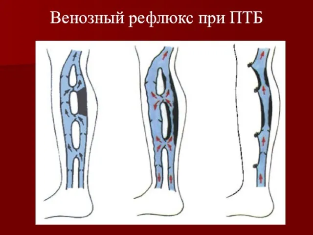 Венозный рефлюкс при ПТБ